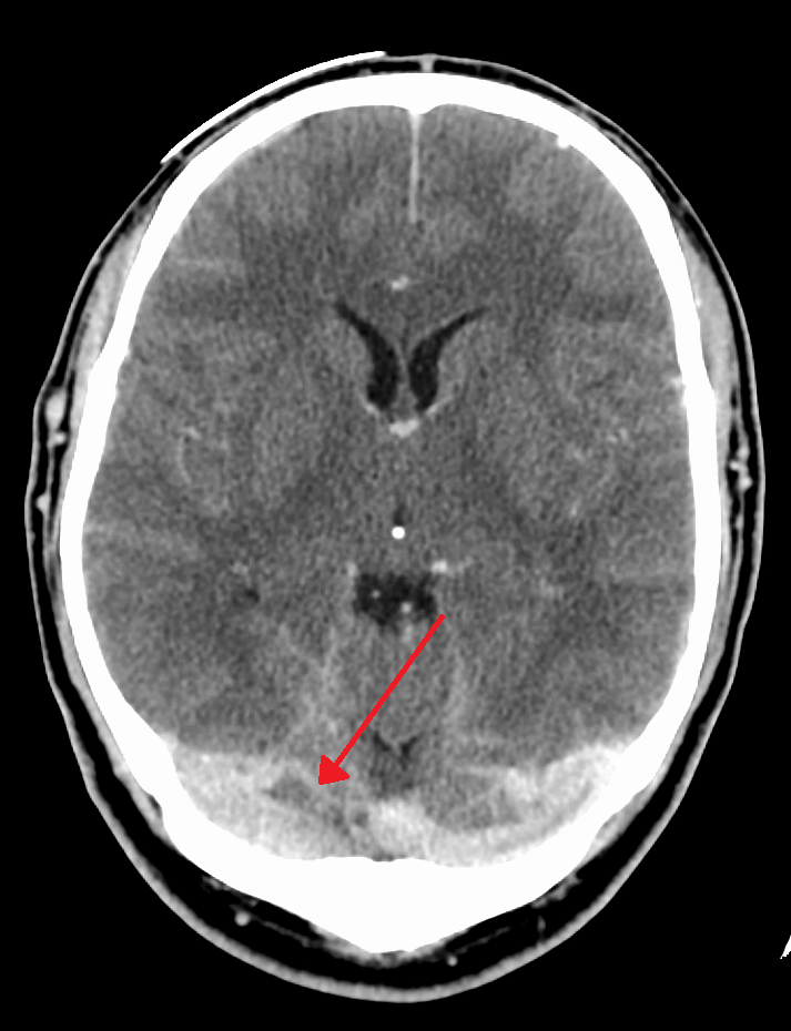 Dural Venous Sinus Thrombosis;Types And Treatment