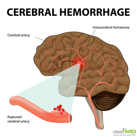 What Is Intracranial Hemorrhage;Causes,Symptoms And Treatment