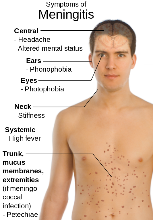 5 Different Types of Meningitis Diseases;You Must Know