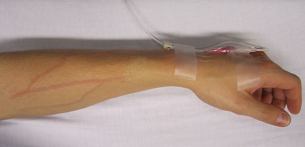 How To Give Intravenous Injection:Guide About Intravenous Injection
