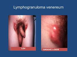 What Is Lymphogranuloma Venereum(LVG);Diagnosis,Treatment,Prevention