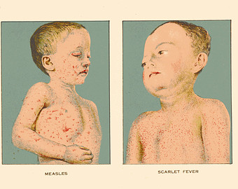 What Is Measles;Causes,Daignosis And Treatment