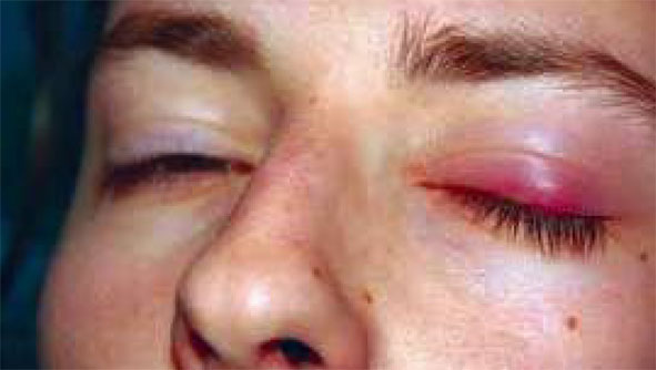 What Is Inclusion Conjunctivitis And Trachoma; Diagnosis,Treatment