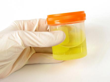 Urine Test Procedure:How To Do Urinalysis Test?