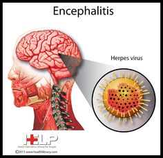 What Is California Encephalitis;Diagnosis,Treatment