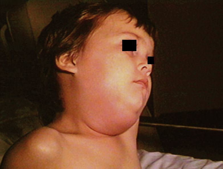 What Is Mumps;Treatment,Diagnosis And Prevention