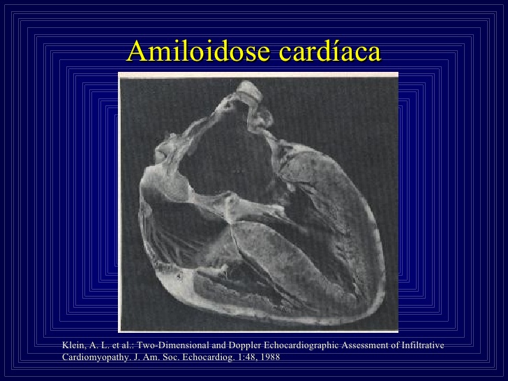 What Is Cardiac Amyloidosis;What Does It Do?