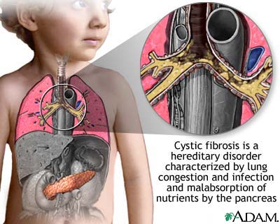 What Is Cystic Fibrosis;Symptoms,Diagnosis And Treatment