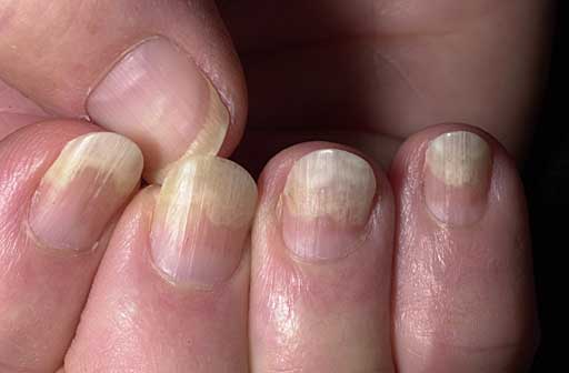 What Is Nail psoriasis;Treatment,Causes And Prevention