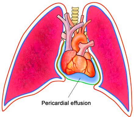 What Is Pericardial Effusion;Causes,Symptoms And Treatment