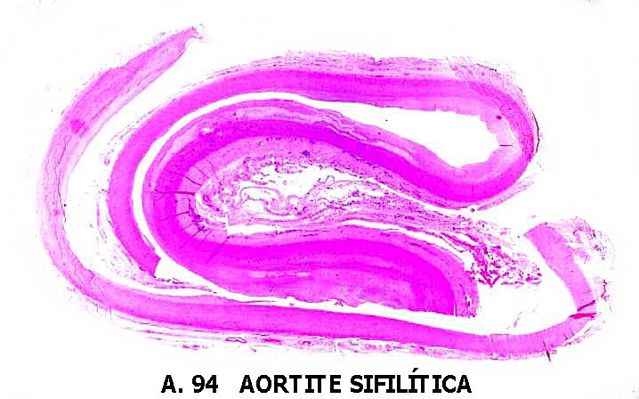 What Is Syphilitic Aortitis;Prognosis And Treatment