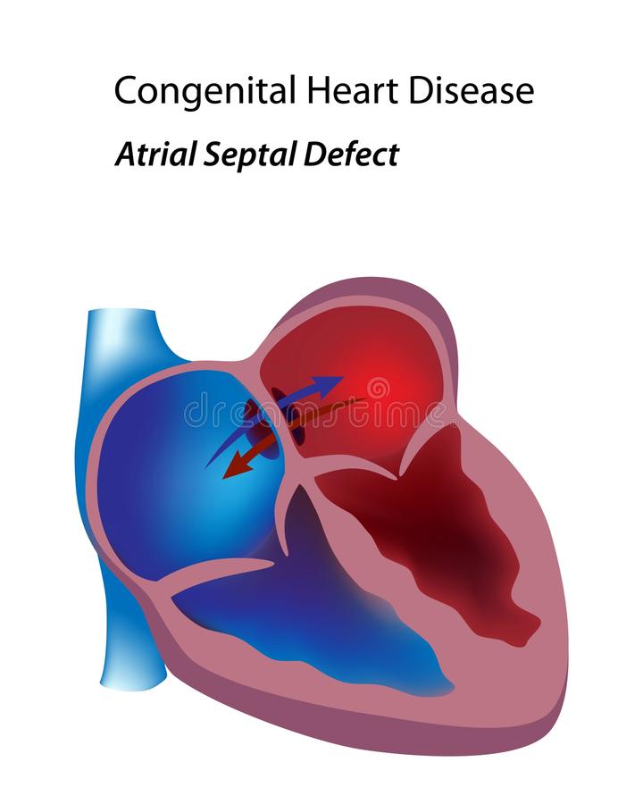 What Is Atrial Septal Defect;History,Diagnosis And Treatment