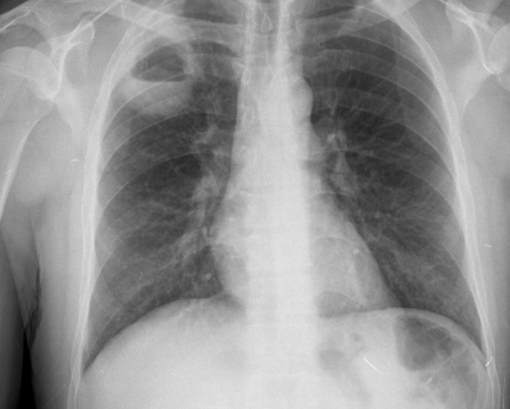 What Is Lung Abscess;Prognosis,Treatment And Prevention