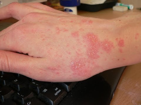 What Is Scabies;How We Can Identify Scabies Disease?