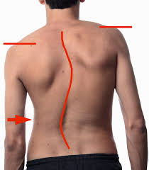 What Is Scoliosis;Prognosis,Treatment And Etiology
