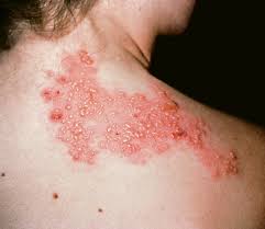 What Is Herpes Zoster;Diagnosis,Treatment And Prevention