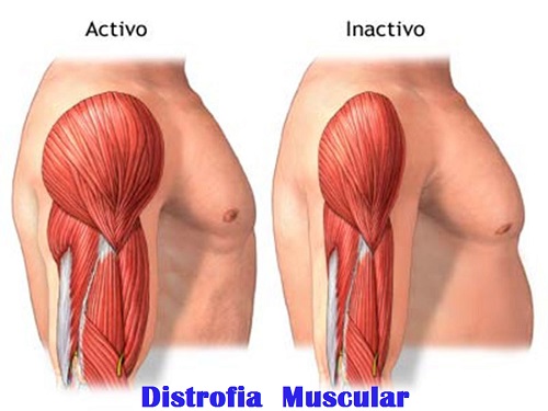 What Is Muscular Dystrophy;Diagnosis,Treatment And Pathology