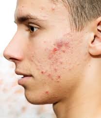 How Acne Begins;5 Medical Facts You Must Know