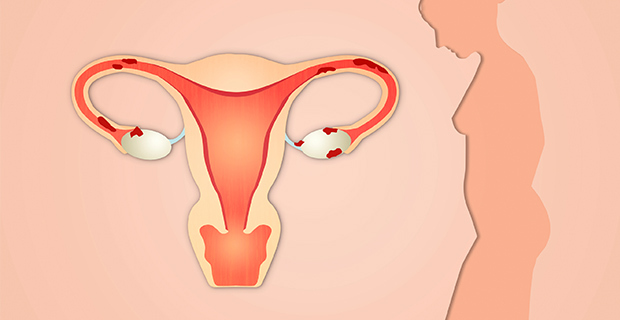 What Is Endometriosis;What Does It Do?